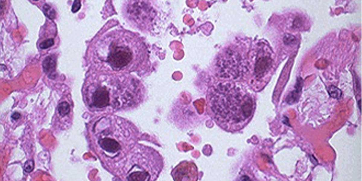 Cytomegalovirus Itu Apa Sih?