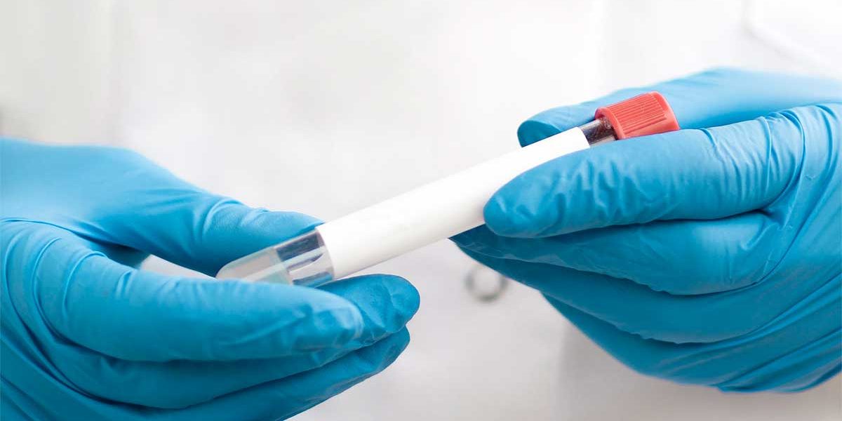 Alasan Mengapa Tes Viral Load itu Sangat Penting